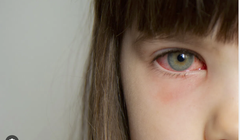 Hôm nay, Sở Y tế TP HCM công bố đã xác định được tác nhân gây bệnh đau mắt đỏ trên địa bàn