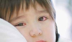 Rất nhiều trẻ em đã phải nhập viện điều trị vì đau mắt đỏ