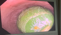 Nam thanh niên nhét con lươn dài 65cm vào hậu môn, phải mổ cấp cứu