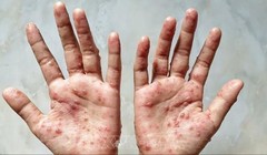 WHO công bố tình trạng khẩn cấp toàn cầu do bệnh đậu mùa khỉ lần thứ hai 