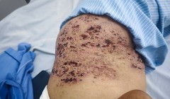 Zona thần kinh ở người cao tuổi dễ bị biến chứng nặng 