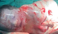 Kỳ diệu bé trai sinh ra trong “bọc điều” ở Hà Nội, chỉ xuất hiện 1/80.000 ca