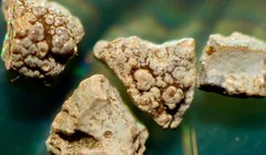 Những mảnh nhỏ của sỏi thận. Ảnh: News Scientist