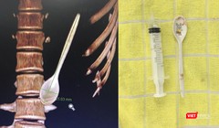 Hình ảnh thìa nhựa bên trong đường tiêu hoá của bệnh nhân từ phim chụp và sau khi lấy ra ngoài