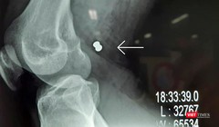 Phim X-ray chụp viên đạn ghim vào đùi gây vở động mạch và tĩnh mạch đùi của bạn nhân