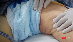 Vết loét điển hình trên vùng bẹn của bệnh nhân sốt mò - một dấu hiệu để phân biệt sốt mò và các bệnh truyền nhiễm khác (ảnh bệnh viện cung cấp)