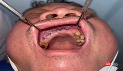 Bệnh nhân sau khi được phẫu thuật điều trị (ảnh bệnh viện cung cấp)