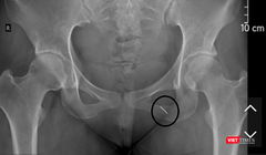 Phim X-quang thể hiện cây kim may đâm và chui sâu vào cơ thể bệnh nhân