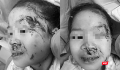 Bệnh nhi Nguyễn Ánh L. bị chó cắn tổn thương nặng vùng đầu và mặt