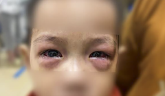 Trẻ bị đau mắt đỏ và gặp biến chứng nặng (ảnh BVCC)