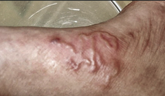 Ấu trùng sán dây chó ký sinh dưới da bệnh nhân (ảnh BVCC)