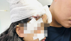 Một trường hợp bệnh nhi bị chó cắn phải nhập viện (Ảnh BVCC)