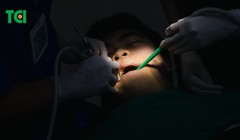 4 răng khôn mọc lệch: Bác sĩ loại bỏ "ám ảnh" cho nam thanh niên bằng công nghệ hiện đại