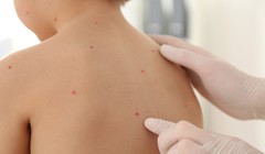 Các nốt phỏng nước nổi khắp cơ thể là biểu hiện điển hình của thủy đậu