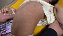 Nhiều trẻ mắc bệnh sởi những ngày đầu năm