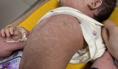 Hơn 1.500 người mắc sởi dịp Tết, dự báo dịch tiếp tục diễn biến phức tạp 