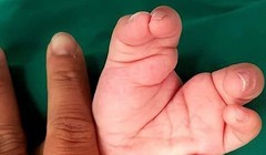 Bé trai hai tuổi vừa được các bác sĩ BV Nhi Đồng cứu thoát khỏi chứng tay chân càng cua 