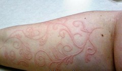 Bệnh lý da vẽ nổi rất hay gặp ở trẻ em, đặc biệt trong mùa mưa (ảnh minh họa)