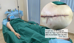 Bệnh nhân bị biến chứng nặng nề sau hút mỡ bụng (Ảnh: BSCC) 