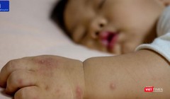 Bệnh tay chân miệng có nhiều biến chứng nguy hiểm. Ảnh: Bệnh viện Đa khoa Tâm Anh