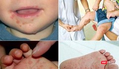 Y tế TP HCM cảnh báo nguy cơ gia tăng tử vong của bệnh tay chân miệng