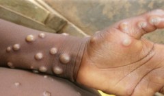 Bệnh đậu mùa khỉ đang lây lan nhanh tại nhiều quốc gia 