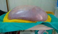 Khối u nặng 8 kg cắt ra từ bụng của chị N.