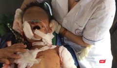 Một trường hợp trẻ em bị thương nặng do chó nhà tấn công