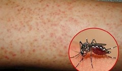 Ảnh minh họa bệnh sốt xuất huyết