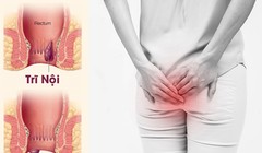 Trĩ gây ảnh hưởng tới sinh hoạt hàng ngày của người bệnh.