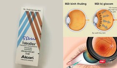 Tự ý sử dụng thuốc Tobradex, đôi mắt có thể bị tổn thương nặng, thậm chí mù lòa.