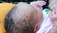 Vừa mới ra đời, em bé này đã phải chịu vết khâu dài 6 mũi.
