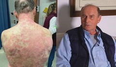 Ông Richard Terrell bị phát ban toàn thân sau khi tiêm vaccine Covid-19 của Johnson & Johnson. Ảnh: Richmond News.