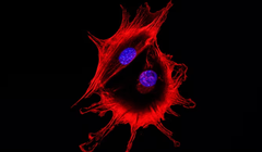 Hình ảnh kính hiển vi của hai tế bào ung thư khi tiếp xúc với nhau. Xét nghiệm dựa trên huyết thanh mới có thể tăng cường phát hiện ung thư ở các nước nghèo (Ảnh: FT)