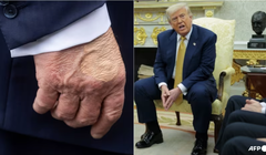 Bàn tay phải của Tổng thống Mỹ Donald Trump được nhìn thấy khi ông phát biểu với báo chí trước khi lên trực thăng vào ngày 15/7 và Tổng thống trong một cuộc họp tại Phòng Bầu dục của Nhà Trắng vào ngày 16/7. Ảnh: AFP.