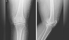 Ảnh chụp X-quang cho thấy hàng trăm sợi chỉ vàng trong đầu gối của nữ bệnh nhân. Ảnh: OddCentral.