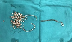 Đoạn stent jj gãy và sỏi lấy ra khỏi cơ thể bệnh nhân