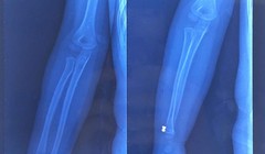 Hình ảnh đạn súng hơi găm trong tay bệnh nhi