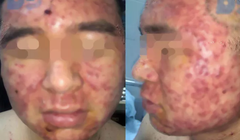 Sử dụng thuốc nam, nam thanh niên bị mụn chi chít. (Ảnh bệnh viện cung cấp)
