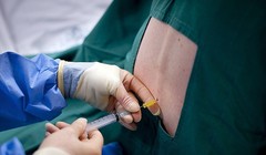 Gây tê tủy sống 