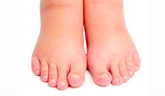 Phù, nề khiến cơ thể sưng đau khó chịu 