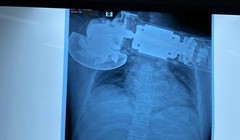 Máy chà cắm găm vào ngực phải của bệnh nhân (Ảnh: BVCC)