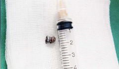 Viên đạn bắn xuyên cổ nam thanh niên 29 tuổi (Ảnh: BVCC) 