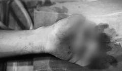 Bé T. đã mất 3 ngón tay do pin của quạt tích điện phát nổ (Ảnh: BVCC) 