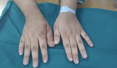 Bàn tay của bệnh nhân sau phẫu thuật (Ảnh: BVCC) 