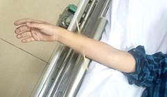 Bé trai 6 tuổi không may bị xiên tre đâm xuyên cẳng tay phải (Ảnh: BVCC)