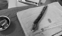 Cây gỗ đâm xuyên vùng mặt của bệnh nhân (Ảnh: BVCC) 