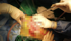 Các bác sĩ phẫu thuật ổ bụng cho bé gái bị thủng bụng, lộ toàn bộ ruột non (Ảnh - BVCC) 