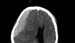 Khối máu tụ lớn trong não của cụ N. (Ảnh - BVCC) 