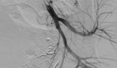 Hình ảnh sau nút mạch quanh động mạch trực tràng của bệnh nhân (Ảnh - BVCC) 